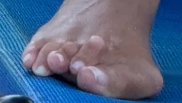 Korekce deformity prstů pravé nohy