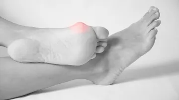 Estetická chirurgie nohy - vbočený palec