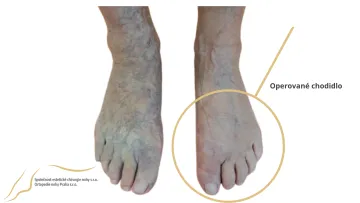 halux po operaci
