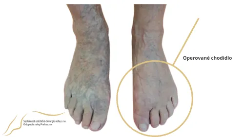 halux po operaci