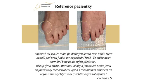 Reference pacienty Estetické chirurgie nohy