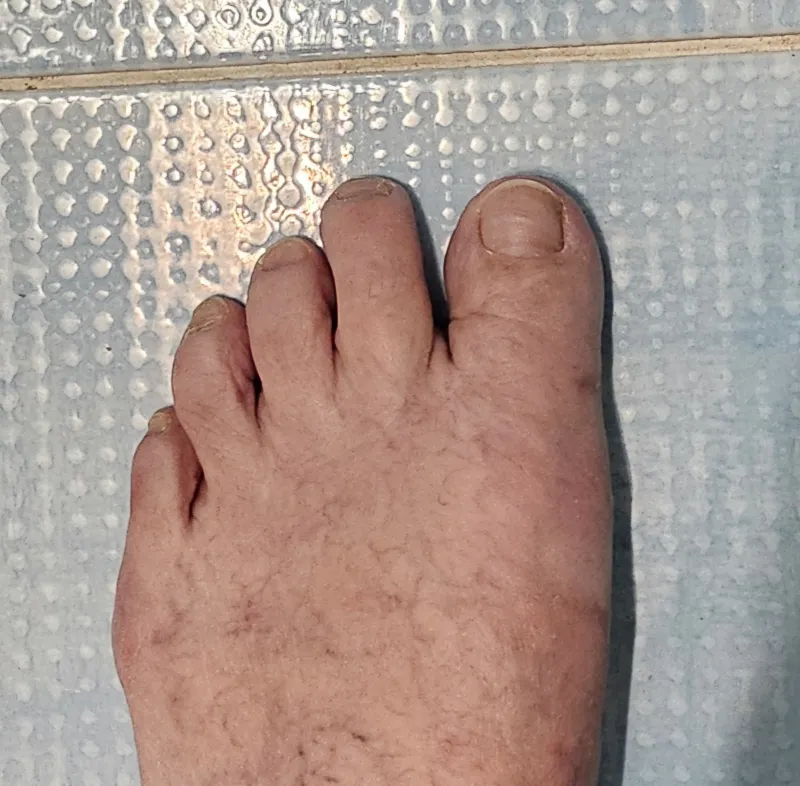 Mini invazivní korekce vbočeného palce - po operaci