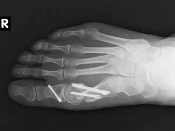 Vbočený palec - Rentgenový snímek šest týdnů po operaci
