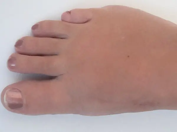 Vbočený palec - Osm týdnů po operaci A