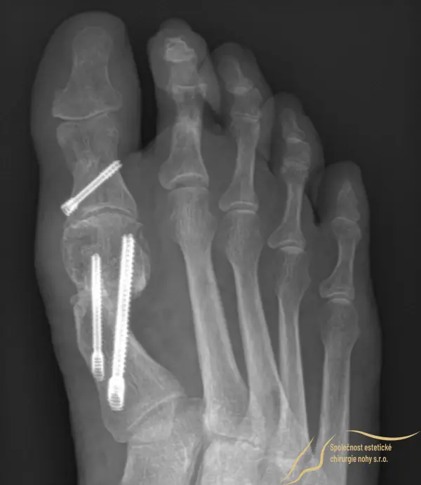 Röntgenová snímka 4 mesiace po operácii