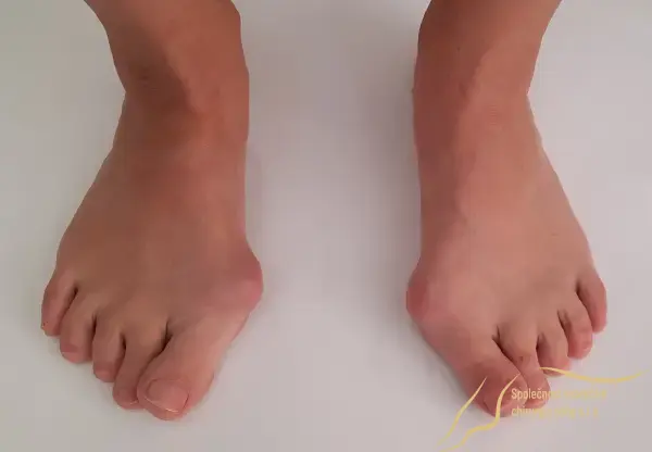 Vbočený palec na obou nohách