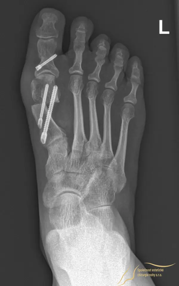 Kosti palce jsou v nové pozici zajištěny pomocí 3 šroubů