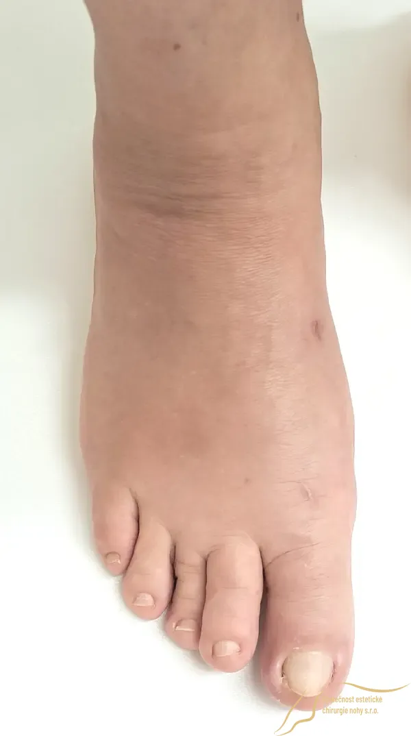 Revizní mini invazivní operace vbočeného palce - leden 2023 - Estetická ...