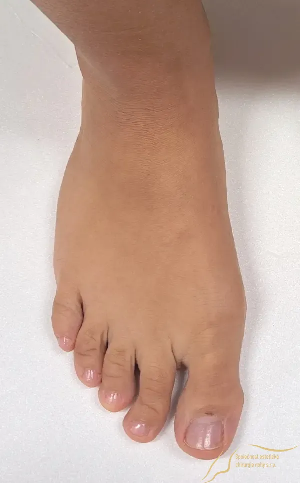Předoperační fotka deformity 2. prstu nohy