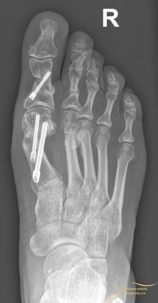 Pooperační rentgenový snímek po zhojení kostí